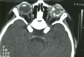 Siatkówczak – zwapnienia w gałce ocznej w obrazie tomografii komputerowej