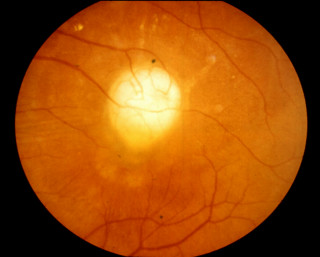 Toksokaroza oczna – mały ziarniniak w plamce siatkówki