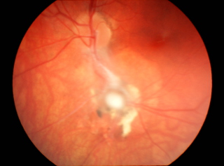 Toksokaroza oczna – ziarniniak poniżej tarczy nerwu wzrokowego z pasmem włóknistym ciągnącym się do tarczy nerwu wzrokowego
