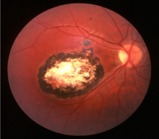 Toksoplazmoza oczna – w plamce siatkówki widoczna okrągła blizna o wysztancowanych brzegach i z dużymi przebarwieniami typowa dla przebytego zarażenia toksoplazmozą