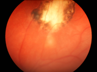 Toksoplazmoza oczna – rekatywacja procesu zapalnego w siatkówce. Widoczna blizna siatkówki po uprzednim stanie zapalnym oraz małe czynne, puszyste ogniska zapalne o nieostrych brzegach ogniska zapalne poniżej