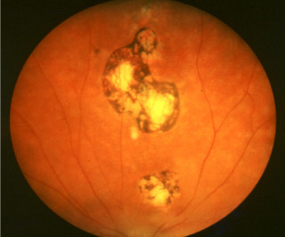 Toksoplazmoza oczna – blizny po reaktywacji stanu zapalnego w siatkówce
