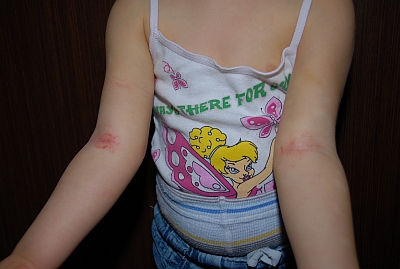 Atopowe zapalenie skóry (AZS) u dziecka - zdjęcie