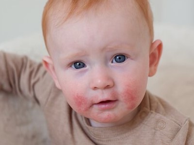 Atopowe zapalenie skóry (AZS) u dziecka - zdjęcie