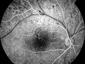 dozarea avastinei în oftalmologie