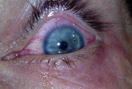 Metaliczne ciało obce w rogówce lewego oka