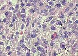 Obraz histologiczny: AZW - liczne komórki plazmatyczne w nacieku zapalnym (strzałki)