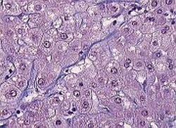 Włóknienie komórek wątroby - zdjęcie