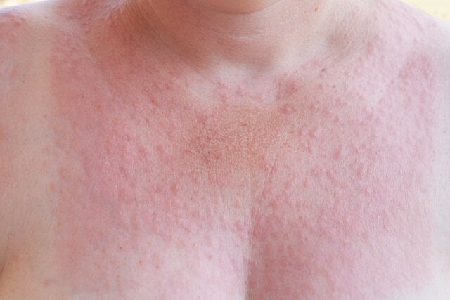 Alergia na słońce – objawy: czerwone grudki, plamy i krosty
