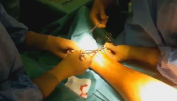 Operacyjne leczenie żylaków