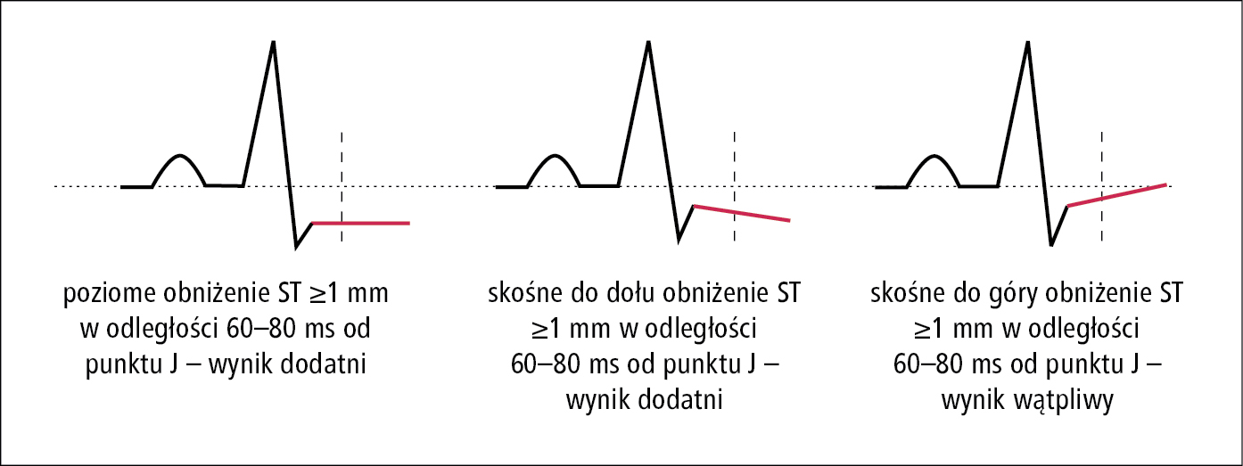    Rycina 25.1-8.    Metody pomiaru obniżenia odcinka ST w EKG wysiłkowym 