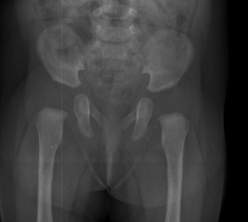   Ryc. 3.  Zdjęcie RTG stawów biodrowych dziecka w wieku 4 miesiące - brak jąder kostnienia głów kości udowych. 