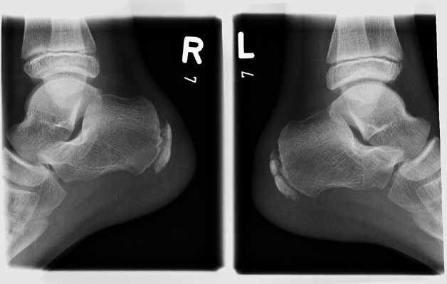   Ryc.  Obraz RTG kości piętowych w projekcji bocznej; prawidłowy obraz jądra kostnienia guza piętowego w stopie prawej (R) oraz obraz typowy dla choroby Haglunda i Severa w stopie lewej (L) – fragmentacja jądra kostnienia guza piętowego. 