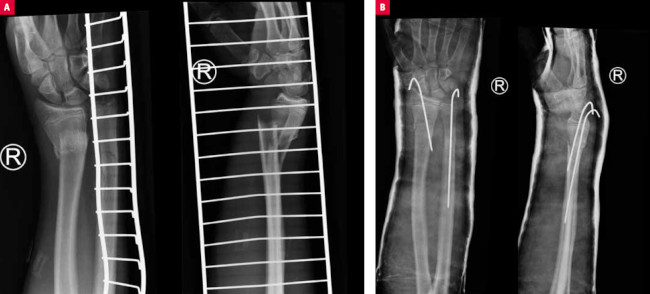   Ryc. 2.  Złamanie przynasady dalszej kości przedramienia ( A ), nastawione zachowawczo i zespolone przezskórnie drutami Kirschnera ( B ) 