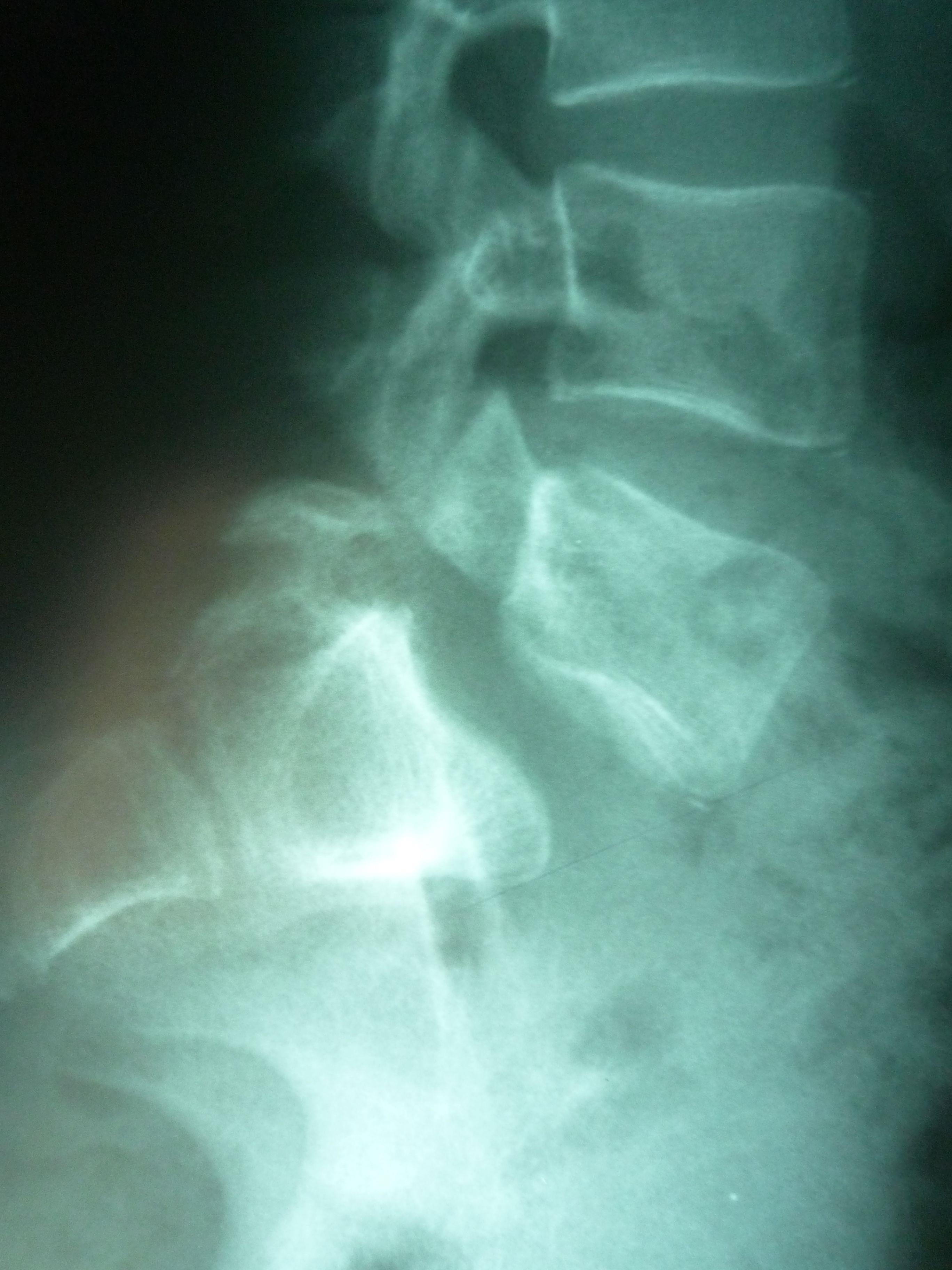    Ryc.   Obraz radiologiczny kręgozmyku – częściowe przemieszczenie trzonów kręgów L5–S1 na zdjęciu radiologicznym w projekcji bocznej 