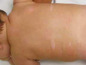   Ryc. 3.  Plamy odbarwieniowe o kształcie liścia jesionu u 5-miesięcznego niemowlęcia chorego na stwardnienie guzowate. 