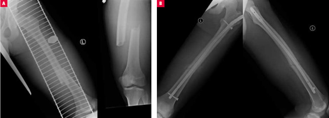   Ryc. 4.  Złamanie trzonu kości udowej z przemieszczeniem odłamów ( A ), leczone operacyjnie i zespolone śródszpikowo gwoździem sztywnym Expert ( B ) 