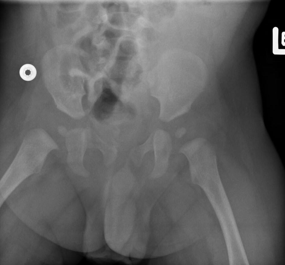   Ryc. 2.  Zdjęcie RTG stawów biodrowych dziecka w dziecka w wieku 3,5 miesiąca - obustronnie widoczne jądra kostnienia głów kości udowych. 