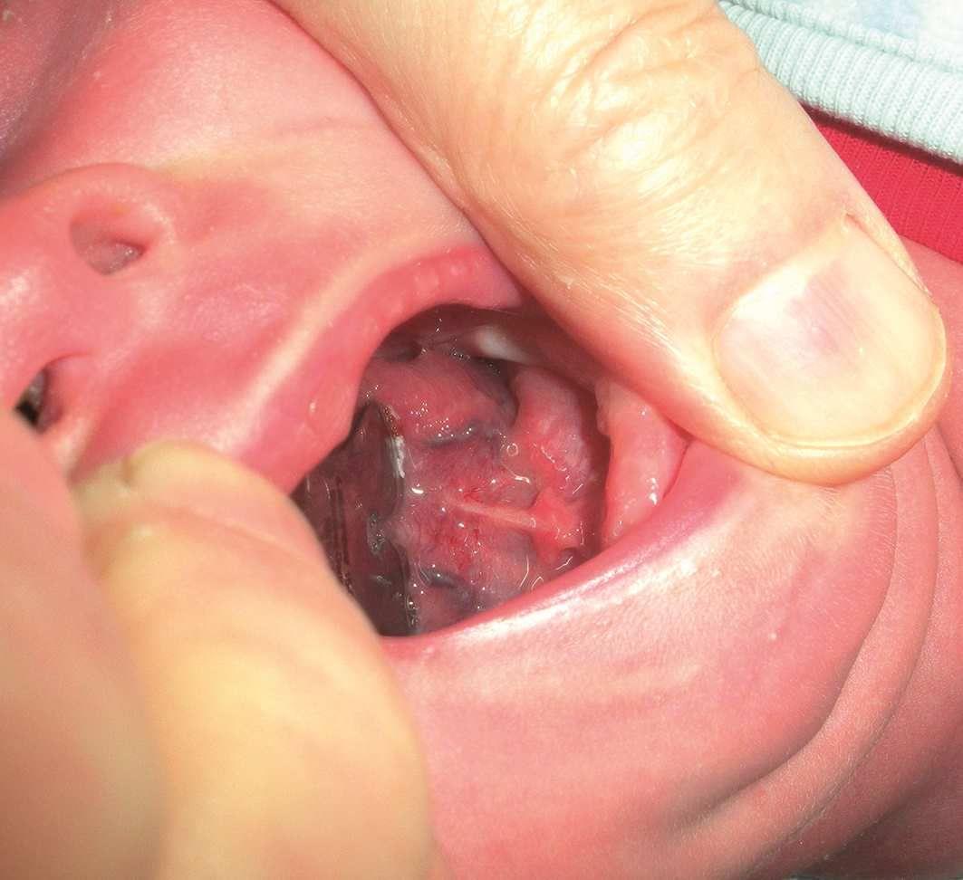   Ryc. 2.   Tylne wędzidełko języka schowane wskutek wycofania języka ku tyłowi jamy ustnej w silnej reakcji obronnej na badanie szpatułką Petita. Wskazane jest badanie palpacyjne. Decyzja odnośnie do frenotomii z uwzględnieniem ewentualnych objawów klinicznych. 