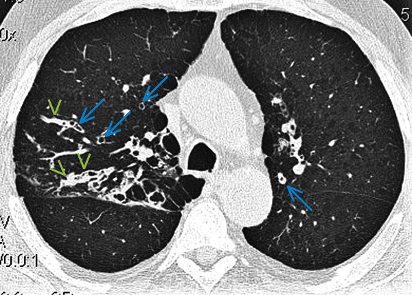 Алергічний бронхолегеневий аспергільоз. КТ у хворого на ХОЗЛ і астму, з еозинофілією периферичної крові, візуалізує у верхніх частках обох легень сегментарні бронхоектази (сині стрілки) i сегментарне 