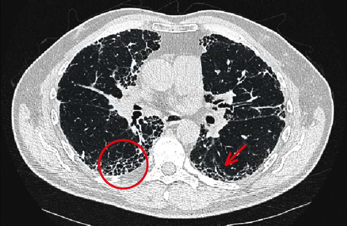 КТВРЗ: типові для звичайної інтерстиціальної пневмонії (ЗІП) ретикулярні ураження в периферичних частинах легенів з ділянками за типом «матового скла» та уражень за типом «стільникової легені» (коло) 