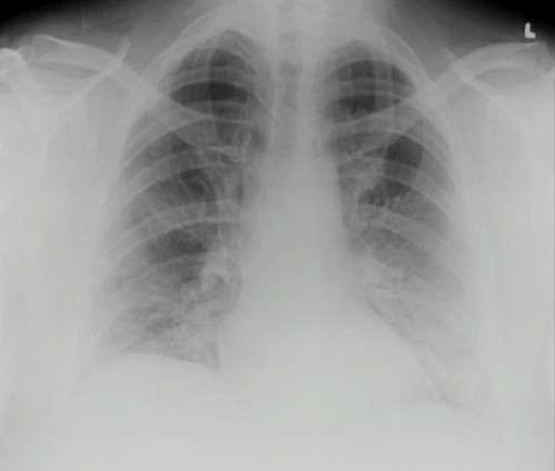 РГ, проведена на 3-тю добу стаціонарного лікування: лінійні та плямисті ущільнення у нижніх відділах обох легенів