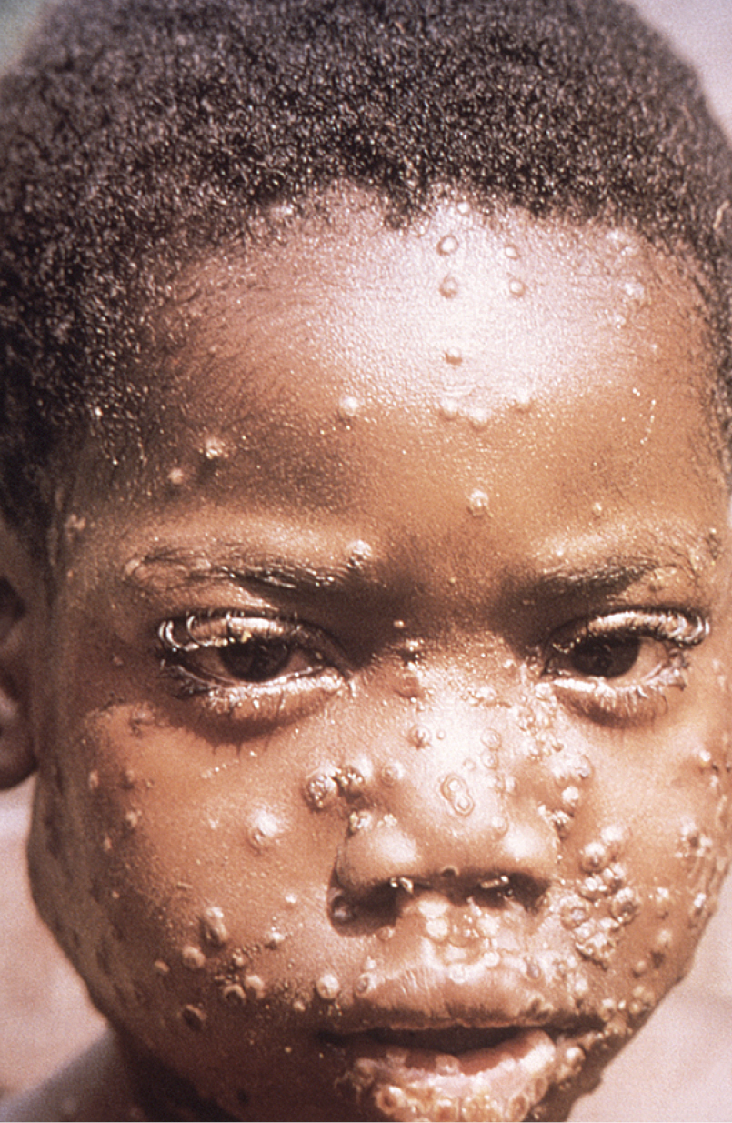 Висип у хлопчика при мавпячій віспі, Заїр (Демократична Республіка Конго), 1997 (фото WHO/Brian W.J. Mahy, BSc, MA, PhD, ScD, DSc; https://phil.cdc.gov/Details.aspx?pid=12783)