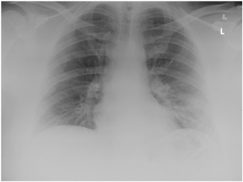  РГ на момент поступлення: нормальна картина легень 