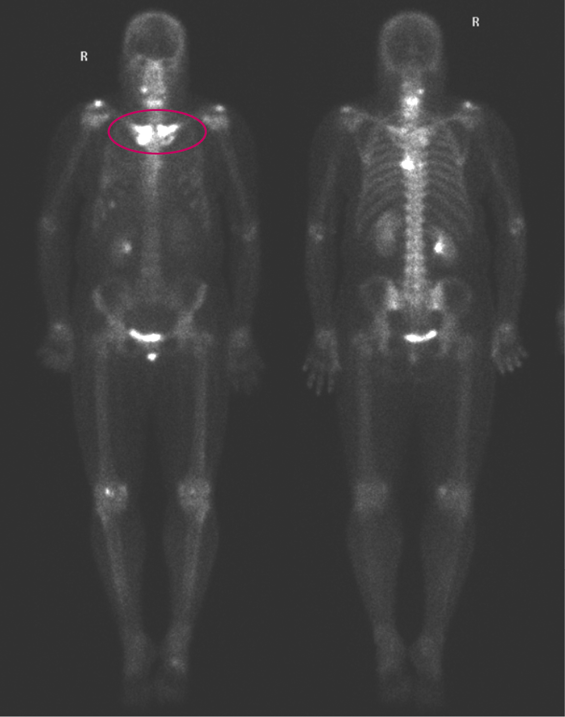 Сцинтиграфія скелета: видно інтенсивне захоплення індикатора в грудино-ключичних суглобах (овал).