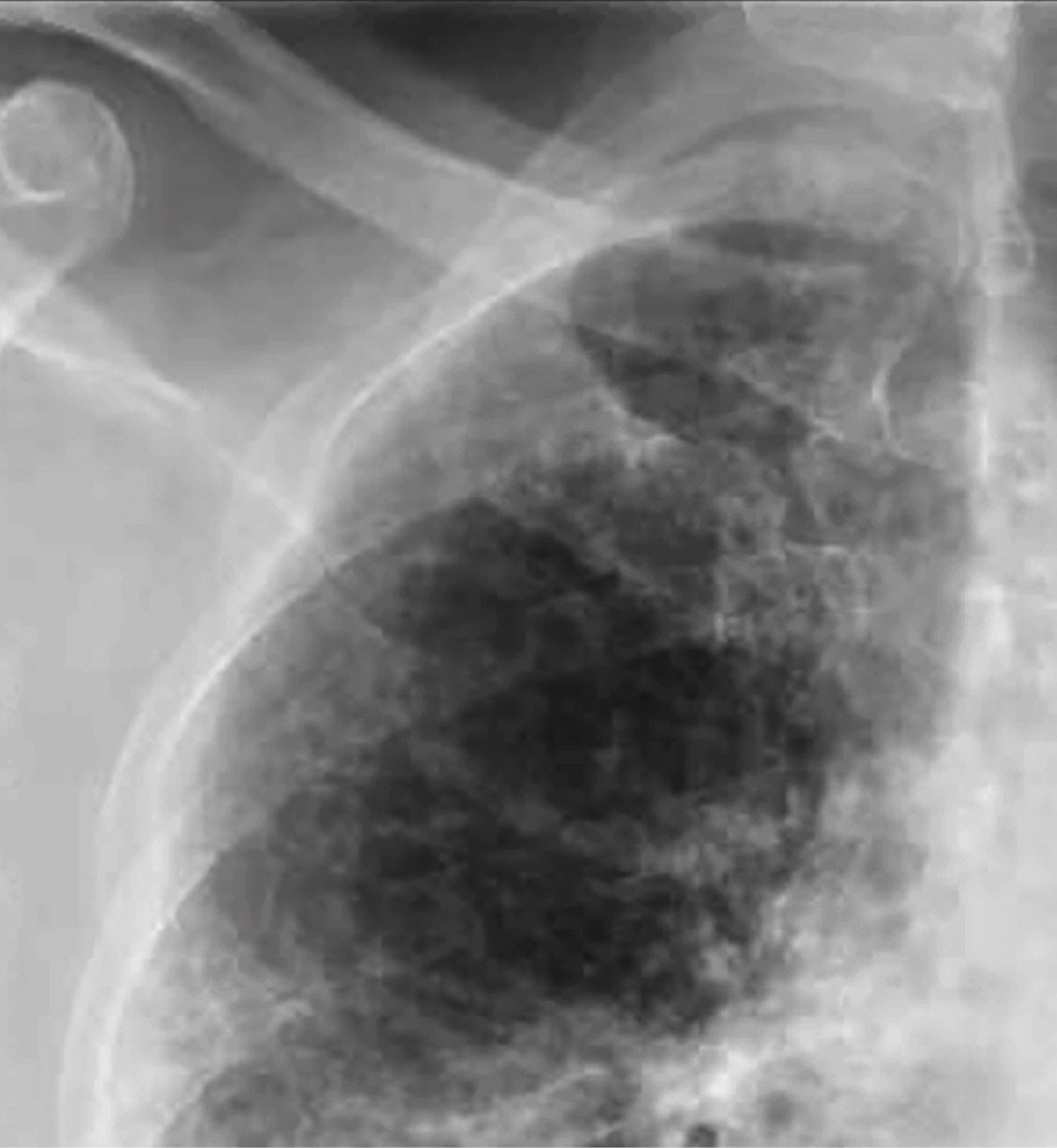  РГ грудної клітки обрізана для кращої візуалізації уражень: численні чіткі ретикулярні затемнення в периферичній частині легені з відносним збереженням центральної частини легені вільною від уражень 