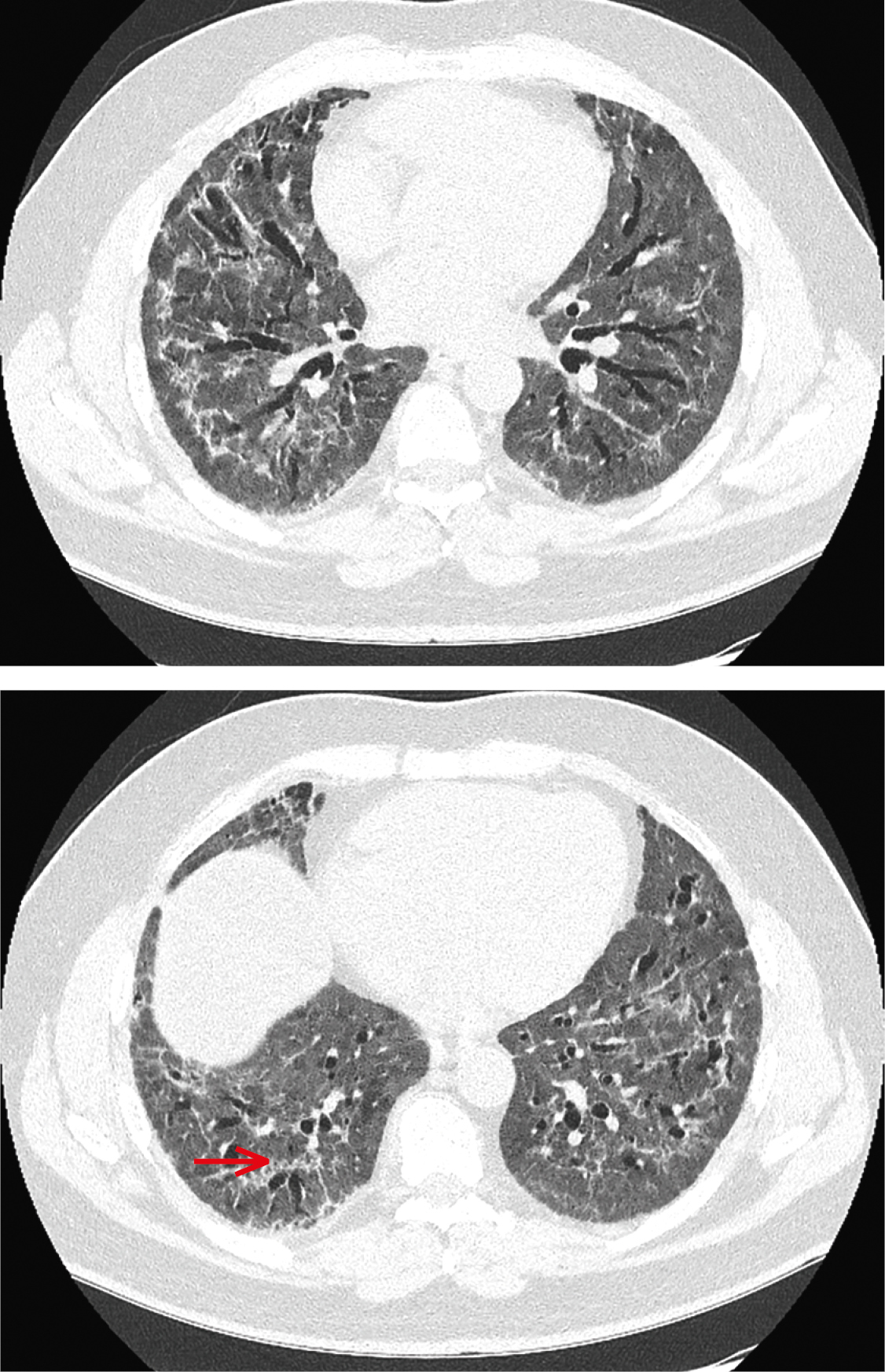 Комп’ютерна томографія грудної клітки на 73-й день симптомів. Обидві легені повністю зайняті ураженнями типу молочного скла, на які накладаються, переважно периферично (також субплеврально біля основи