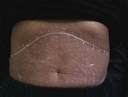 Гіперпігментація шкіри в пацієнтів із цирозом печінки може зберігатися протягом тривалого часу після трансплантації печінки (фото зроблено через рік після операції)