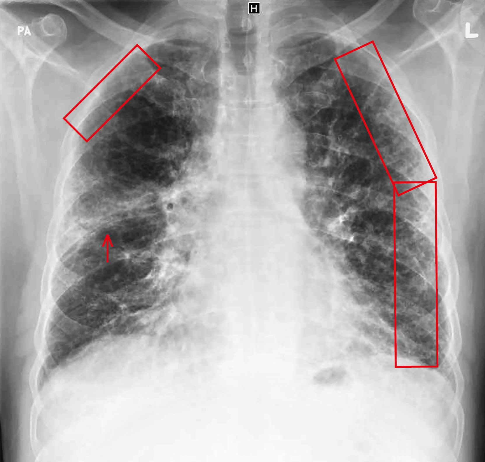 РГ грудної клітки із зазначеними ураженнями: в обох легенях помітні ретикулярні інтерстиціальні ураження (прямокутники), які розташовані периферично і не охоплюють центральні відділи легеневих полів. 