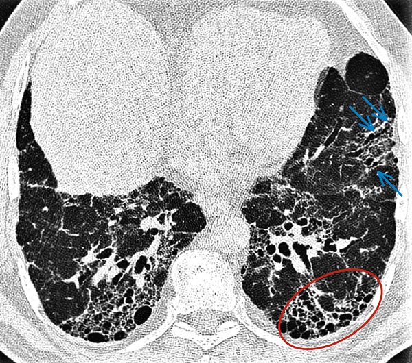 Інтерстиціальна пневмонія з ознаками фіброзу у хворого на ідіопатичний фіброз легень. Візуалізуються ділянки завершеного фіброзу (ділянки 