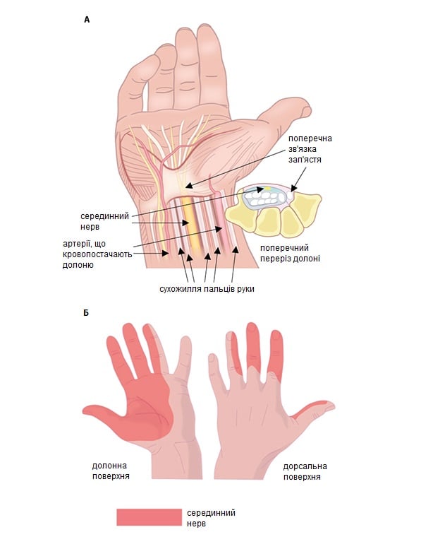 Синдром зап'ястного каналу: А — поперечний переріз долоні, Б — зона іннервації серединного нерва