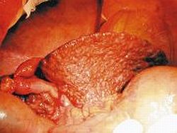 Зовнішній вигляд циротичної печінки (видно регенераційні вузлики)