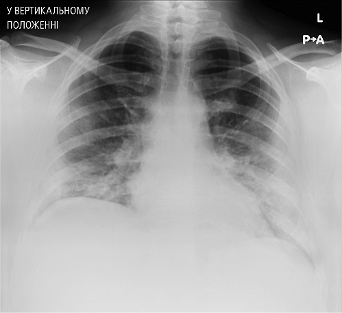  РГ, виконана на 6-ту добу госпіталізації: ущільнення легеневої паренхіми у нижніх полях обох легень та в середній частині (периферично) правого легеневого поля 