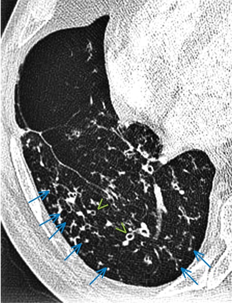 Мікобактеріоз легень. КТ у хворого з загостренням ХОЗЛ візуалізує сегментарні бронхоектази (зелені стрілки) та інтралобулярні вузлики, розміщені по ходу дрібних бронхів – симптом 