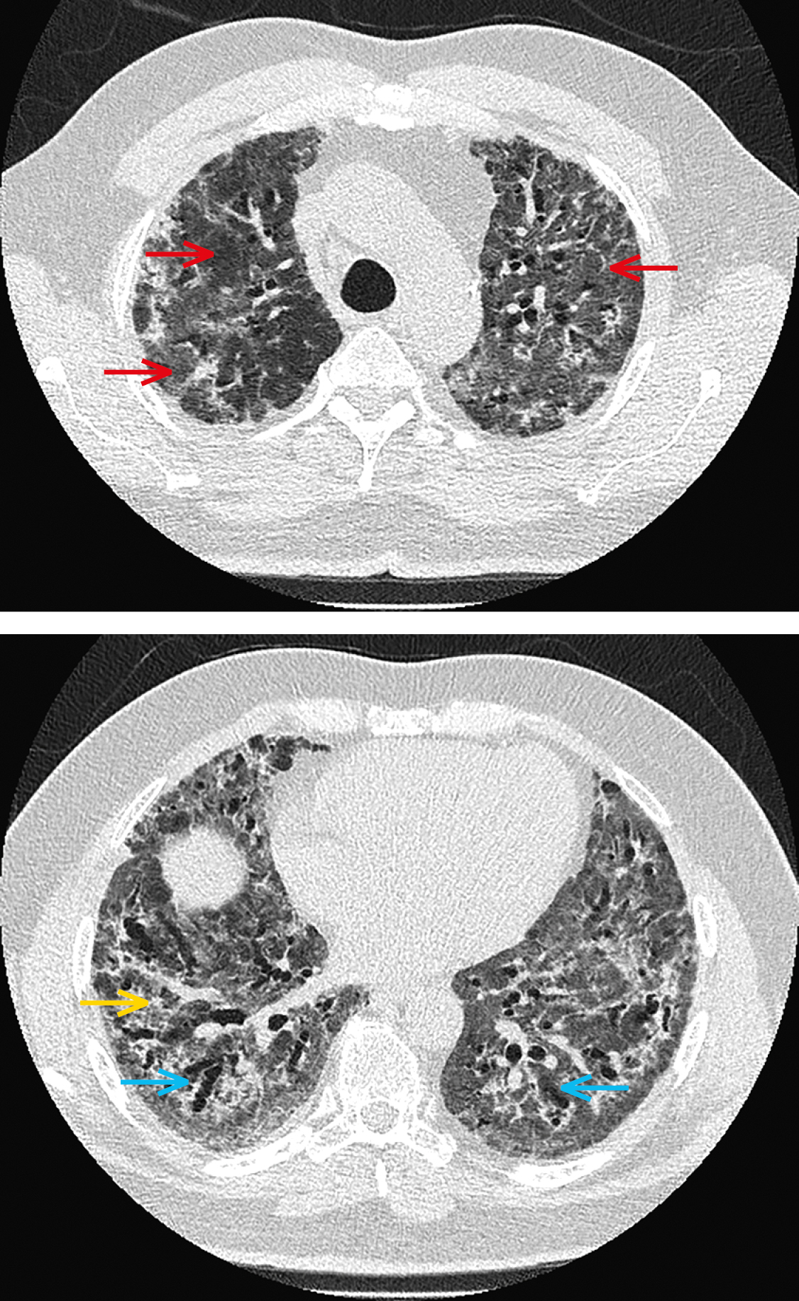 Контрольна комп'ютерна томографія грудної клітки. Обширні ущільнення за типом молочного скла (червоні стрілки) в обох легенях, частково зображення бруківки (жовта стрілка) і зони консолідації, що пере