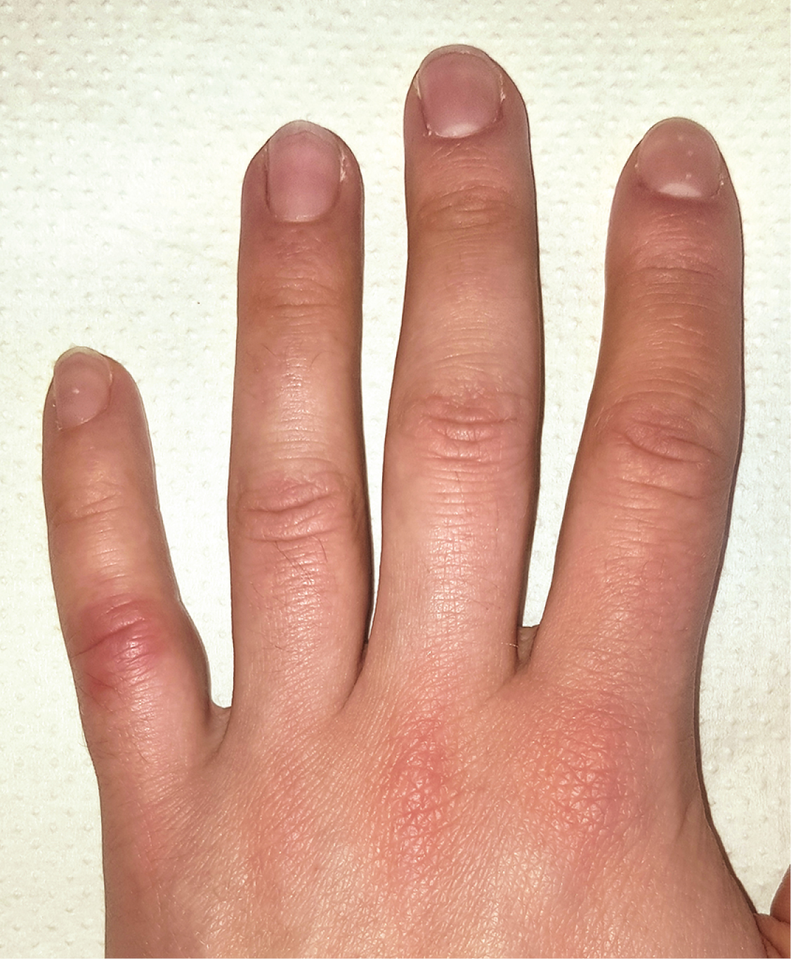 Еритематозні зміни над міжфаланговим суглобом V пальця.