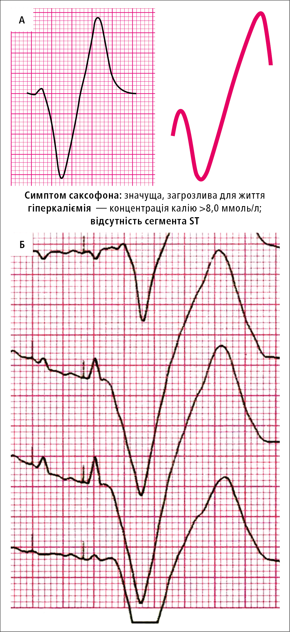 A — схематичне зображення симптому саксофона. Б — симптом саксофона у обговорюваного хворого — збільшення комплексу QRS з відведень V4, V5 i V6