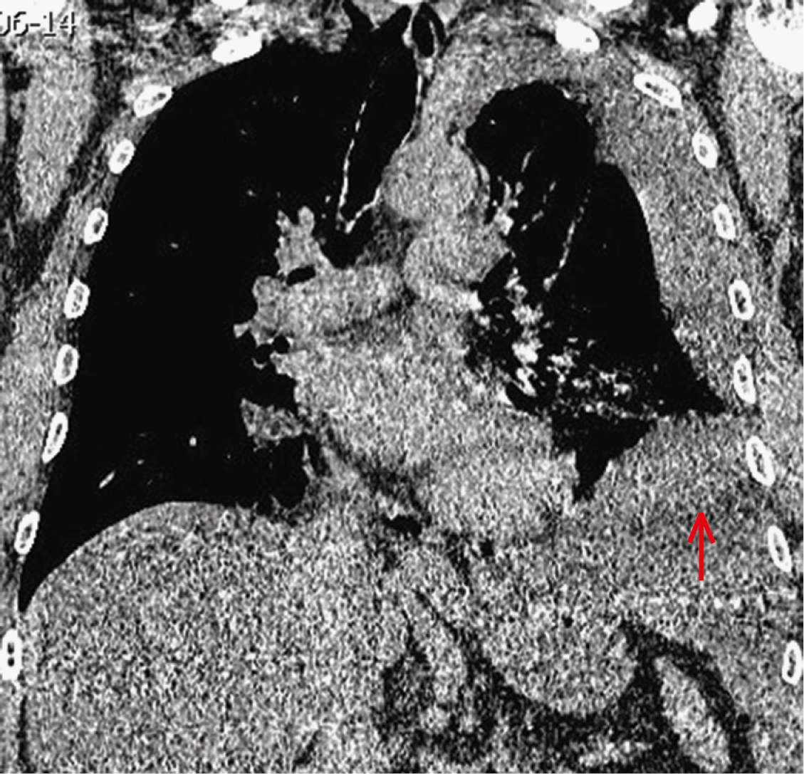  Мультифазна комп'ютерна томографія органів грудної клітки з контрастуванням, виконана у день поступлення — рідина у лівій плевральній порожнині (стрілка) 