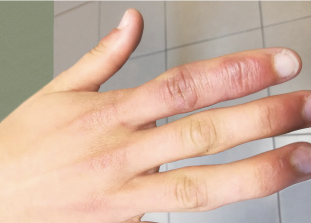 Ураження шкіри в дистальних частинах пальців рук