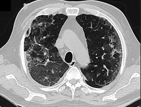 Кавернозні ураження легень, спричинені пневмонією в ході COVID‑19