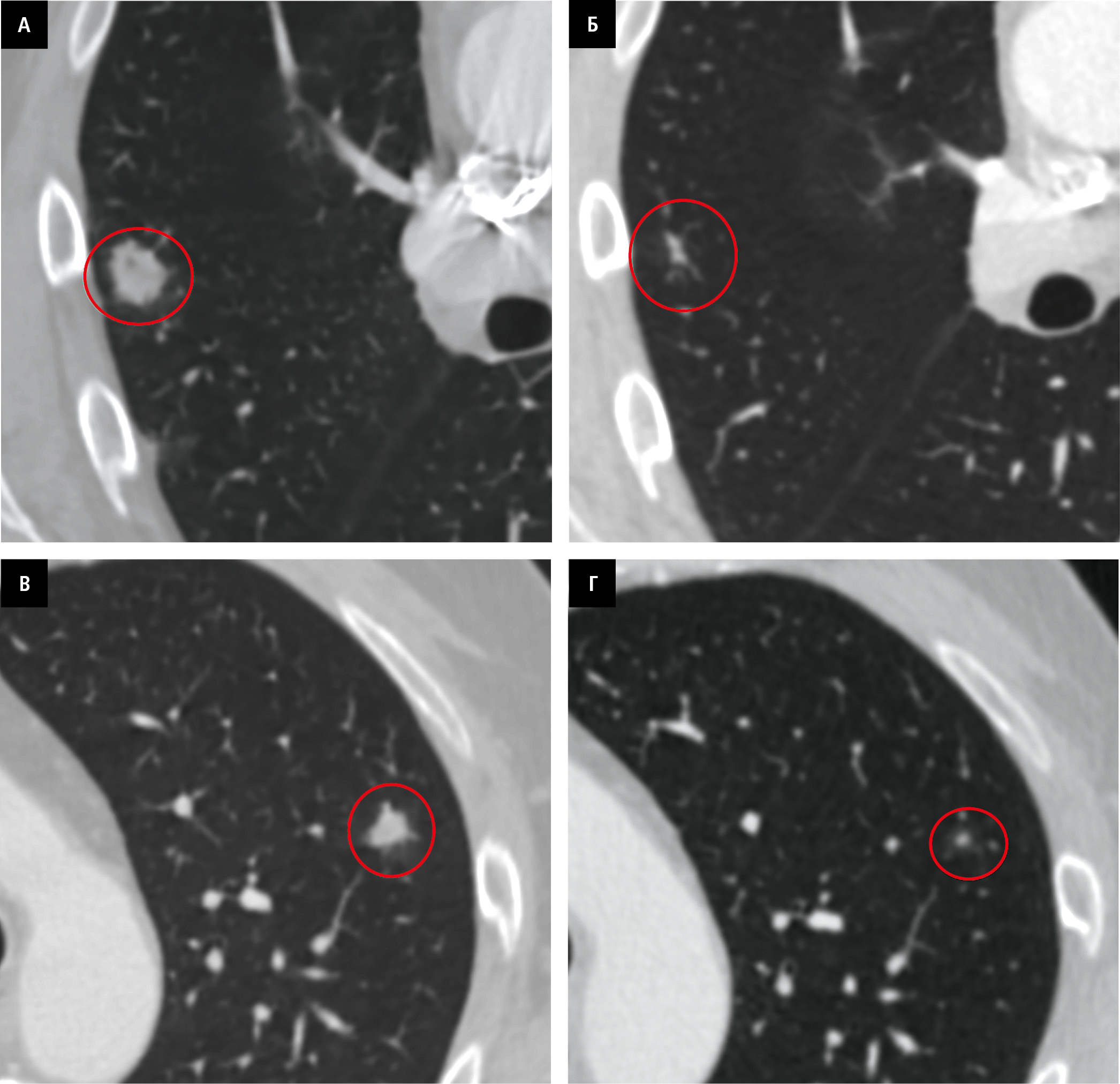На КТ візуалізуються: вузлові зміни (позначені червоними колами) у лівій легені (A) та правій легені (В) та їх регрес через 3 місяці (Б та Г відповідно)