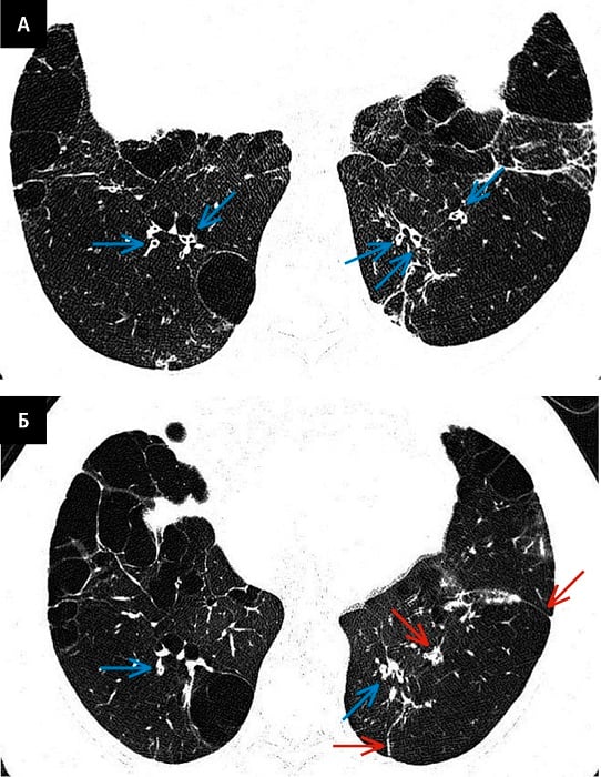 Непрямі ознаки бронхоектазів на КТ-картині у 78‑річної хворої на ХОЗЛ з деструктивною бульозною емфіземою і дихальною недостатністю. A — КТ-картина на вдиху візуалізує потовщення стінок незначно розши