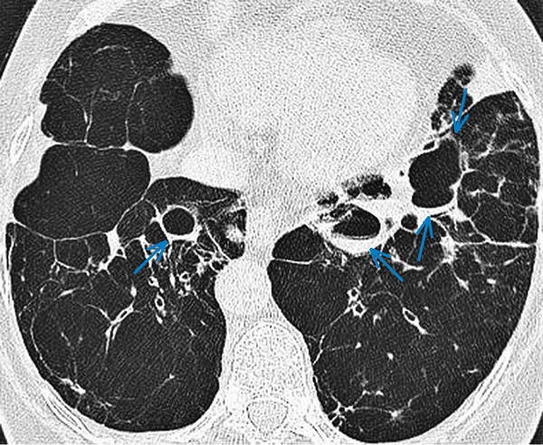 Кістозний бронхоектаз. Кістозно розширені бронхи (сині стрілки) у VII сегменті правої легені та в ділянці язичка лівої легені
