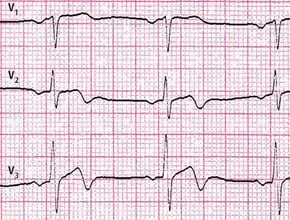 Електрокардіограма при апікальній кардіоміопатії, тобто ЕКГ важлива, але клінічна картина — найважливіша