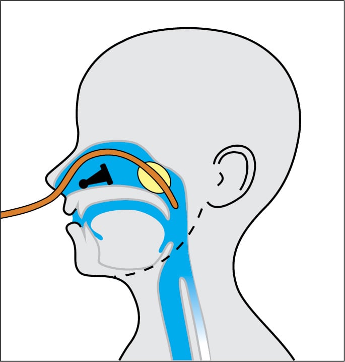 Видалення стороннього тілa з носової порожнини за допомогою катетера Фолея