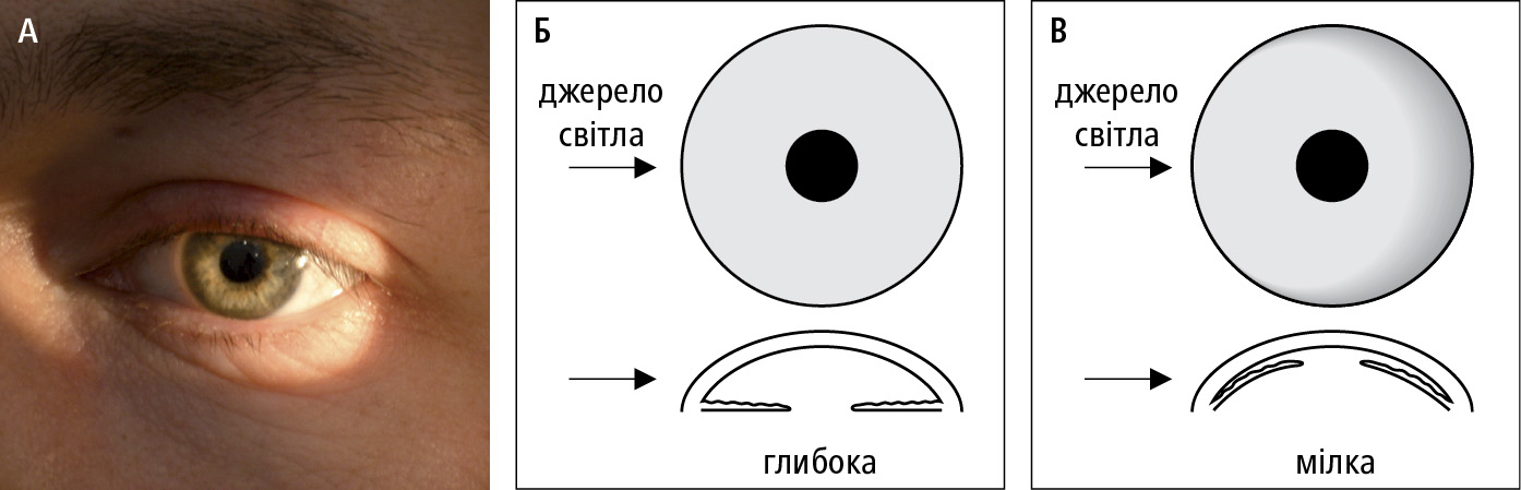  Оцінка глибини передньої камери oкa.  А  і  Б  — рівномірно освітлені скроневa і носовa частини райдужної оболонки ока (глибoкa передня камерa oкa — нормальнa).  B  — освітленa тільки скроневa частинa райдужної оболонки ока (мілкa передня камерa oкa — pизик закриття кутa фільтрації)  
